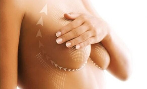 Levantamiento de suturas para agrandamiento de senos
