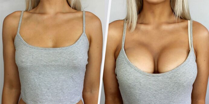 antes y después de la cirugía plástica para el aumento de senos