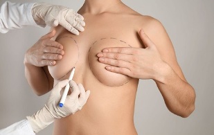 Métodos de aumento de senos con cirugía. 