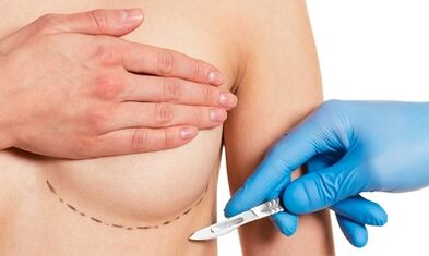 Acceso submamático a la agrandamiento de los senos con implantes