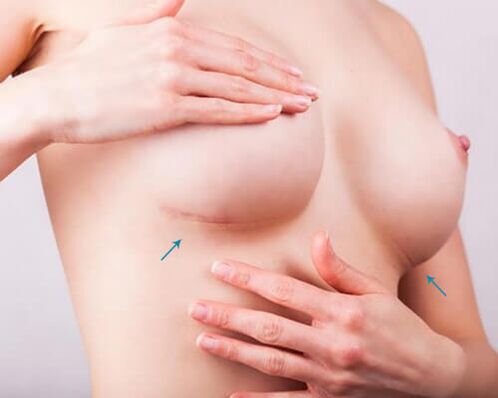 Aumento de senos con implantes